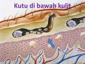 Jangkitan Kutu Air Pada Kaki