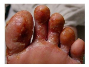 Jangkitan Kutu Air Pada Kaki